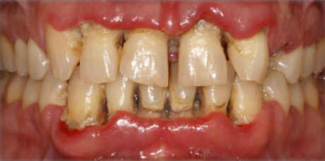 Periodontitis necrosante 